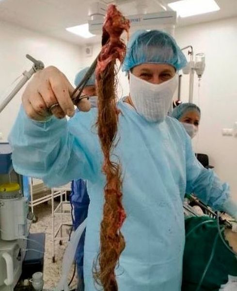 خارج کردن توده مو از شکم زن جوان