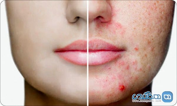 علت جوش زدن صورت نوجوانان چیست؟ + راه حل
