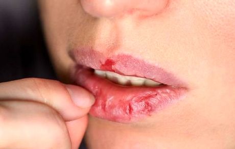 راهکاری طلایی برای درمان خشکی لب در پاییز و زمستان