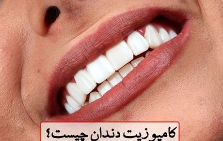 قیمت کامپوزیت دندان 1404 + شرایط کامپوزیت قسطی در تهران