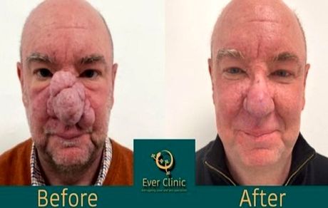 مرد فیلی درمان شد + عکس