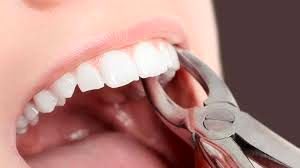 این دلایل خبر می دهند که باید دندانتان را بکشید